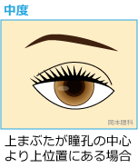 上まぶたが瞳孔の中心より上位置にある場合 眼瞼下垂日帰り手術 富山市天正寺 岡本眼科（がんけんかすい）